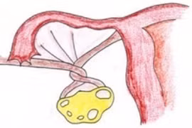 Bé 13 tuổi bị xoắn 7 vòng vòi buồng trứng phải