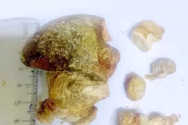 Lấy sỏi san hô 7 cm, bảo tồn thận cho người bệnh 70 tuổi