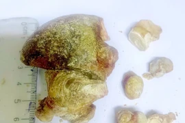 Lấy sỏi san hô 7 cm, bảo tồn thận cho người bệnh 70 tuổi