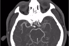 Giải pháp điều trị hiệu quả đột quỵ khi thức giấc vào buổi sáng