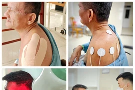 Giải pháp phục hồi bán trật khớp vai sau đột quỵ