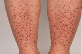 Cẩn thận trẻ phát ban do viêm mạch IgA gây hỏng thận