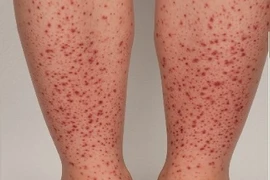 Cẩn thận trẻ phát ban do viêm mạch IgA gây hỏng thận