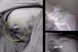 Phẫu thuật gãy xương trên màn hình C.Arm, đơn giản hóa những ca bệnh phức tạp