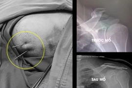 Phẫu thuật gãy xương trên màn hình C.Arm, đơn giản hóa những ca bệnh phức tạp