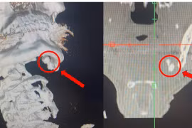 Sưng đau vùng hàm không ngờ sỏi tuyến nước bọt