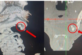 Sưng đau vùng hàm không ngờ sỏi tuyến nước bọt