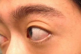 Trợn mắt, lồi mắt do cố ý hay bệnh tuyến giáp?