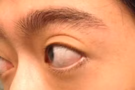 Trợn mắt, lồi mắt do cố ý hay bệnh tuyến giáp?