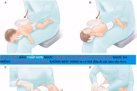 Bác sĩ hướng dẫn cách thực hiện thủ thuật Heimlich đúng tránh biến chứng