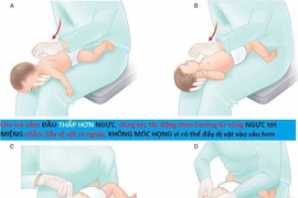 Bác sĩ hướng dẫn cách thực hiện thủ thuật Heimlich đúng tránh biến chứng