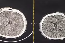 Hạ thân nhiệt chỉ huy cứu sống thanh niên phù não sau thắt cổ tự tử