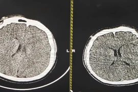 Hạ thân nhiệt chỉ huy cứu sống thanh niên phù não sau thắt cổ tự tử