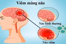 Các loại viêm màng não thường gặp