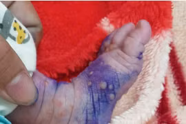 30% trẻ sơ sinh mắc thủy đậu tử vong, cách gì phòng tránh?