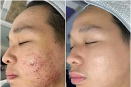  Chăm sóc da tránh mụn trứng cá ở tuổi dậy thì