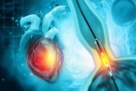 Chụp mạch vành qua đường ống thông có gây nguy hiểm?