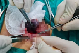 Gần 100 ca xoắn tinh hoàn, chỉ 29 ca bảo tồn được