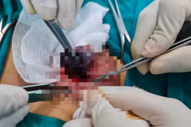 Gần 100 ca xoắn tinh hoàn, chỉ 29 ca bảo tồn được