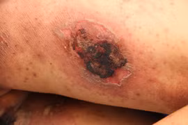 Đắp kiến ba khoang chữa ngứa, thanh niên 25 tuổi bị tổn thương da toàn thân