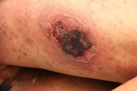 Đắp kiến ba khoang chữa ngứa, thanh niên 25 tuổi bị tổn thương da toàn thân