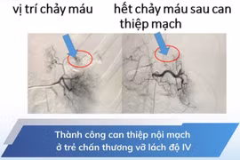 Can thiệp nội mạch cứu trẻ 5 tuổi vỡ lách độ IV