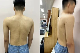 Khám sàng lọc, chẩn đoán hình ảnh miễn phí bệnh gù, vẹo cột sống trẻ em