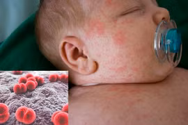 Địa chỉ vàng: Các loại vắc xin phòng bệnh sởi 