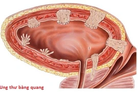Bác sĩ chỉ rõ các yếu tố nguy cơ ung thư bàng quang