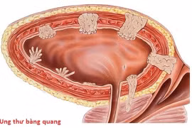 Bác sĩ chỉ rõ các yếu tố nguy cơ ung thư bàng quang