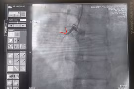 Can thiệp giành lại sự sống cho bệnh nhân ngừng tim vô cùng nguy kịch