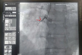 Can thiệp giành lại sự sống cho bệnh nhân ngừng tim vô cùng nguy kịch