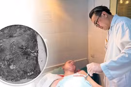 Bé 14 tuổi bị nhiễm trùng nặng do điều trị bỏng bằng thuốc nam