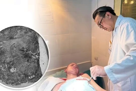 Bé 14 tuổi bị nhiễm trùng nặng do điều trị bỏng bằng thuốc nam