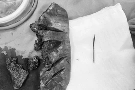 Cụ ông 77 tuổi phải cắt gan vì thói quen người Việt thường mắc