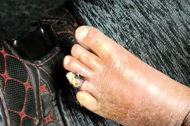 Can thiệp nội mạch “cứu” chân hoại tử cho người tắc động mạch chi dưới