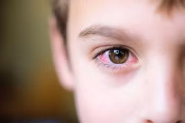 Bác sĩ mách cách phòng ngừa bệnh viêm kết mạc mùa xuân