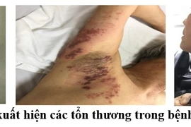 Điều trị chứng đau sau mắc zona thần kinh bằng vật lý trị liệu