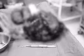 Đón bé chào đời an toàn đồng thời được loại bỏ u xơ tử cung lớn