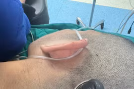 Cứu thành công nam học sinh bị chìa khóa cắm sâu vào đầu