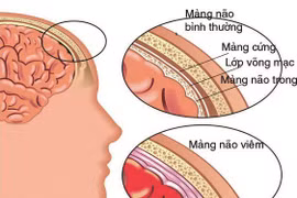 50% nhiễm trùng huyết do não mô cầu tử vong, cách gì phòng tránh