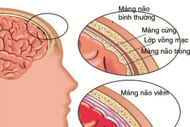 50% nhiễm trùng huyết do não mô cầu tử vong, cách gì phòng tránh