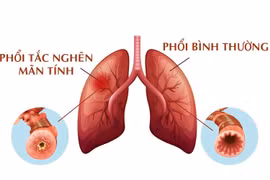 Cách chung sống hòa bình với bệnh phổi tắc nghẽn hơn 380 triệu người mắc