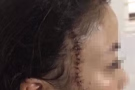 Đang ngồi chơi, thiếu nữ 18 tuổi bất ngờ bị nhóm bạn cũ xông vào rạch mặt