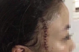 Đang ngồi chơi, thiếu nữ 18 tuổi bất ngờ bị nhóm bạn cũ xông vào rạch mặt