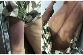  2 ngày ở nhà tạm giữ, nam thanh niên tử vong sau, người đầy vết bầm tím