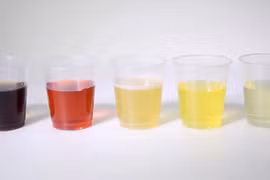 Màu sắc nước tiểu nói lên điều gì về sức khoẻ của bạn? 