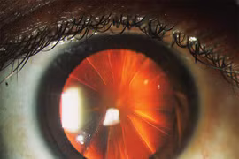 Kỳ lạ người phụ nữ có đôi mắt như chiếc bánh pizza cắt lát