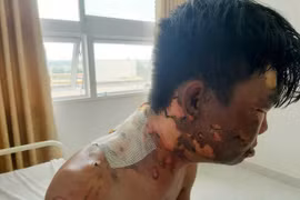 Thanh niên bị chị ruột đổ nước sôi vào đầu