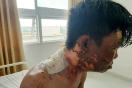 Thanh niên bị chị ruột đổ nước sôi vào đầu